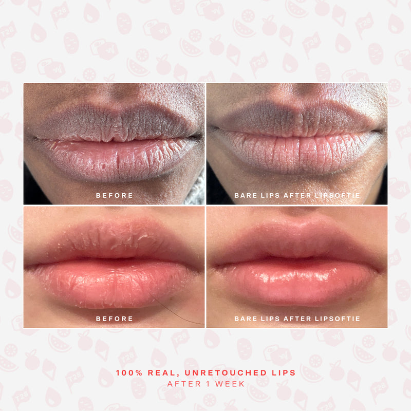 SOS LipSoftie® Lip Treatment