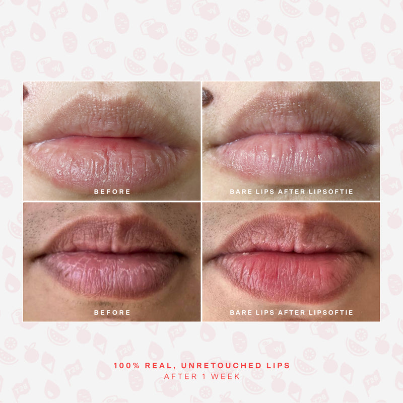 LipSoftie® Lip Treatment Set